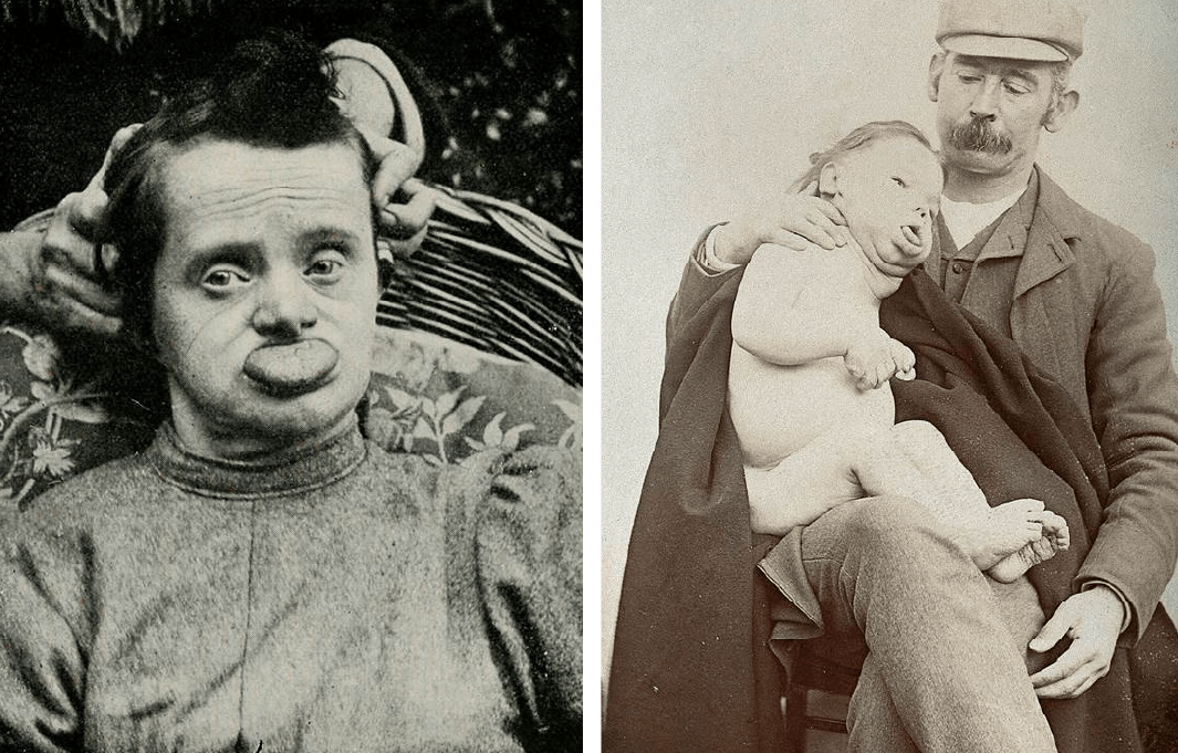 Left image: A vintage photo of a woman with Down syndrome with her tongue hanging out of her mouth. Right: A vintage photo of a father holding his naked son with Down syndrome