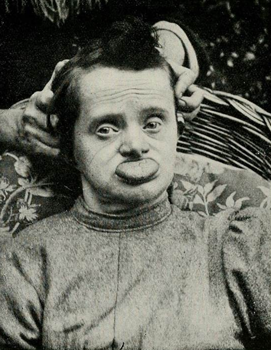 A vintage photo of a man with Down syndrome with his tongue hanging out of his mouth
