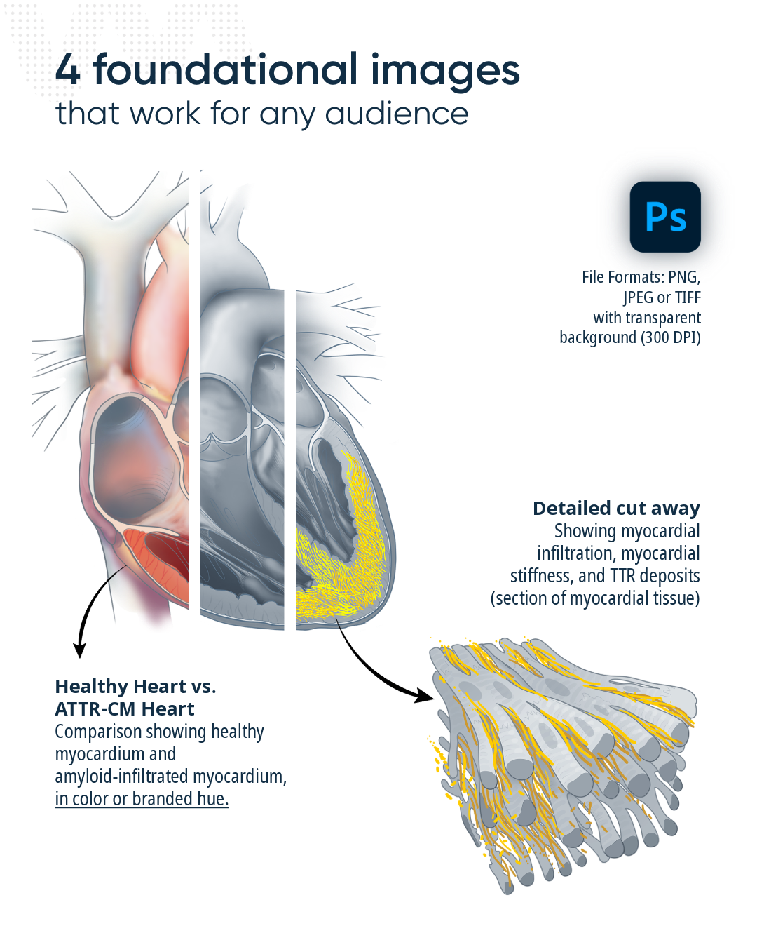 Diagram comparing the structure of a human heart with and without a specific condition, showing anatomical features and nerve connections, labeled with text and icons.