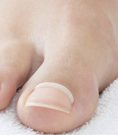 Podiatrist applying Onyfix nail correction composite to an ingrown toenail at Performance Podiatry Ohio