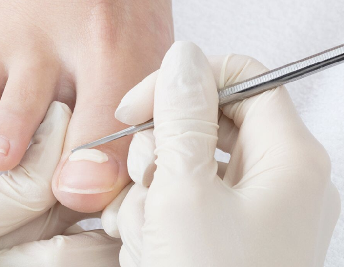 Podiatrist applying Onyfix nail correction composite to an ingrown toenail at Performance Podiatry Ohio