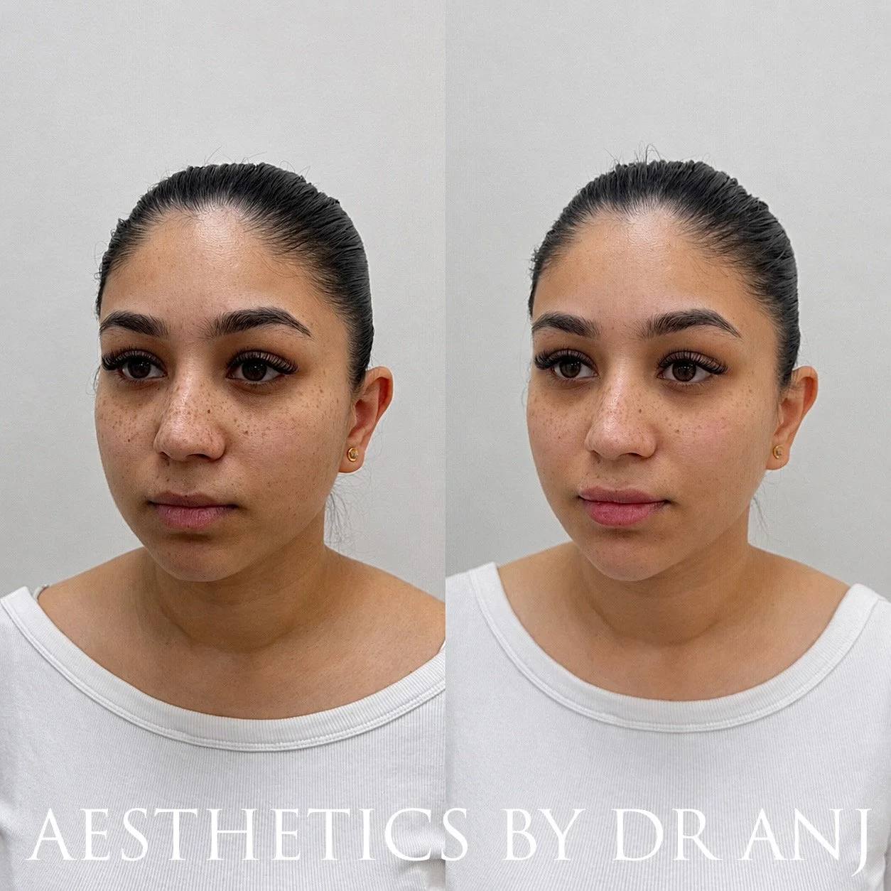 Lower Facial Balancing: Filler to lips, chin, chin shadow and jawline slimming (lips freshly done so swollen)