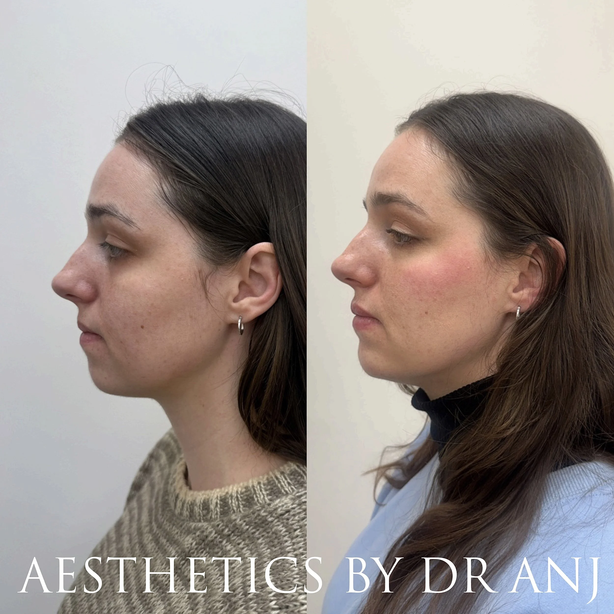 facial balancing london natural lip filler