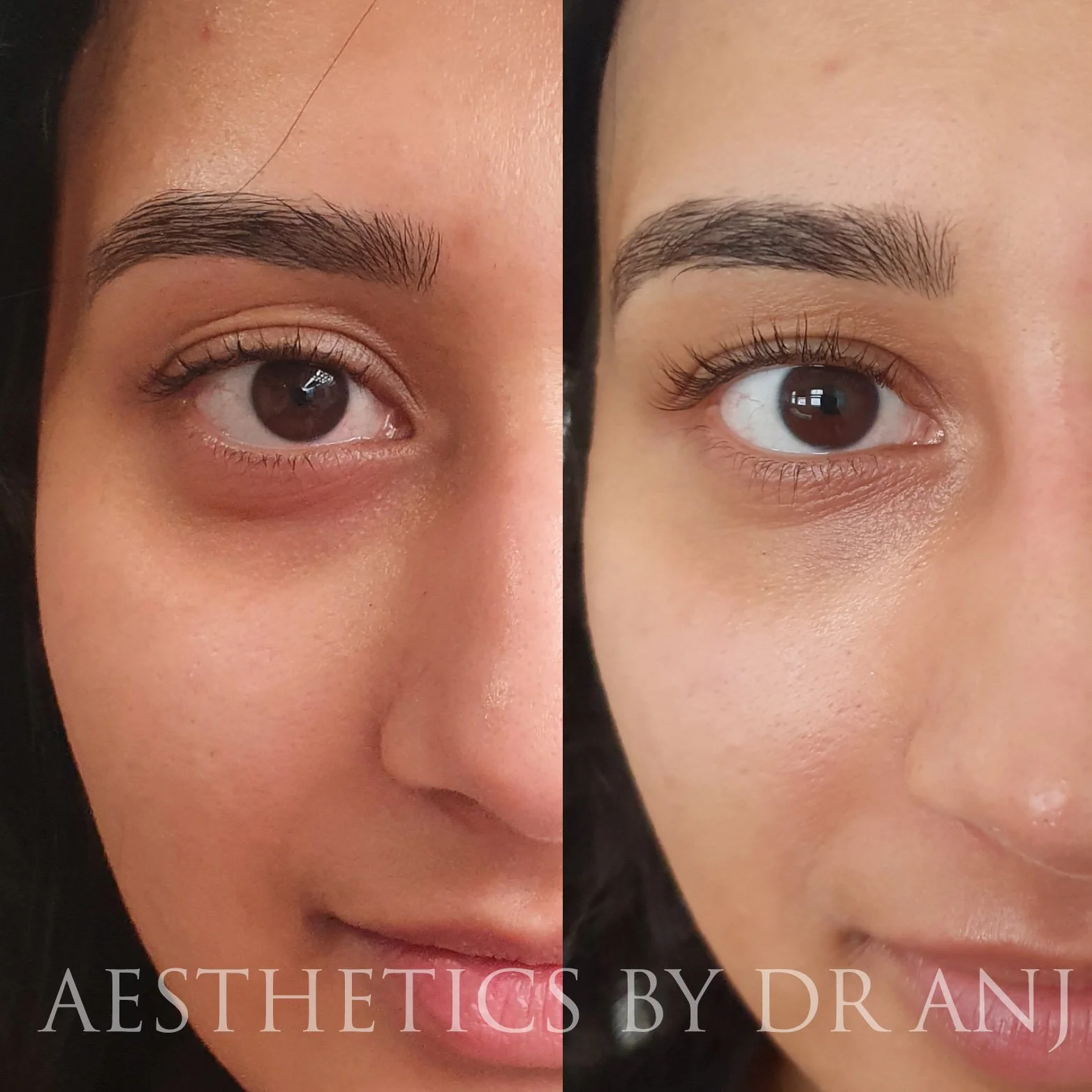 Undereye Mesotherapy — Aesthetics by Dr Anj
