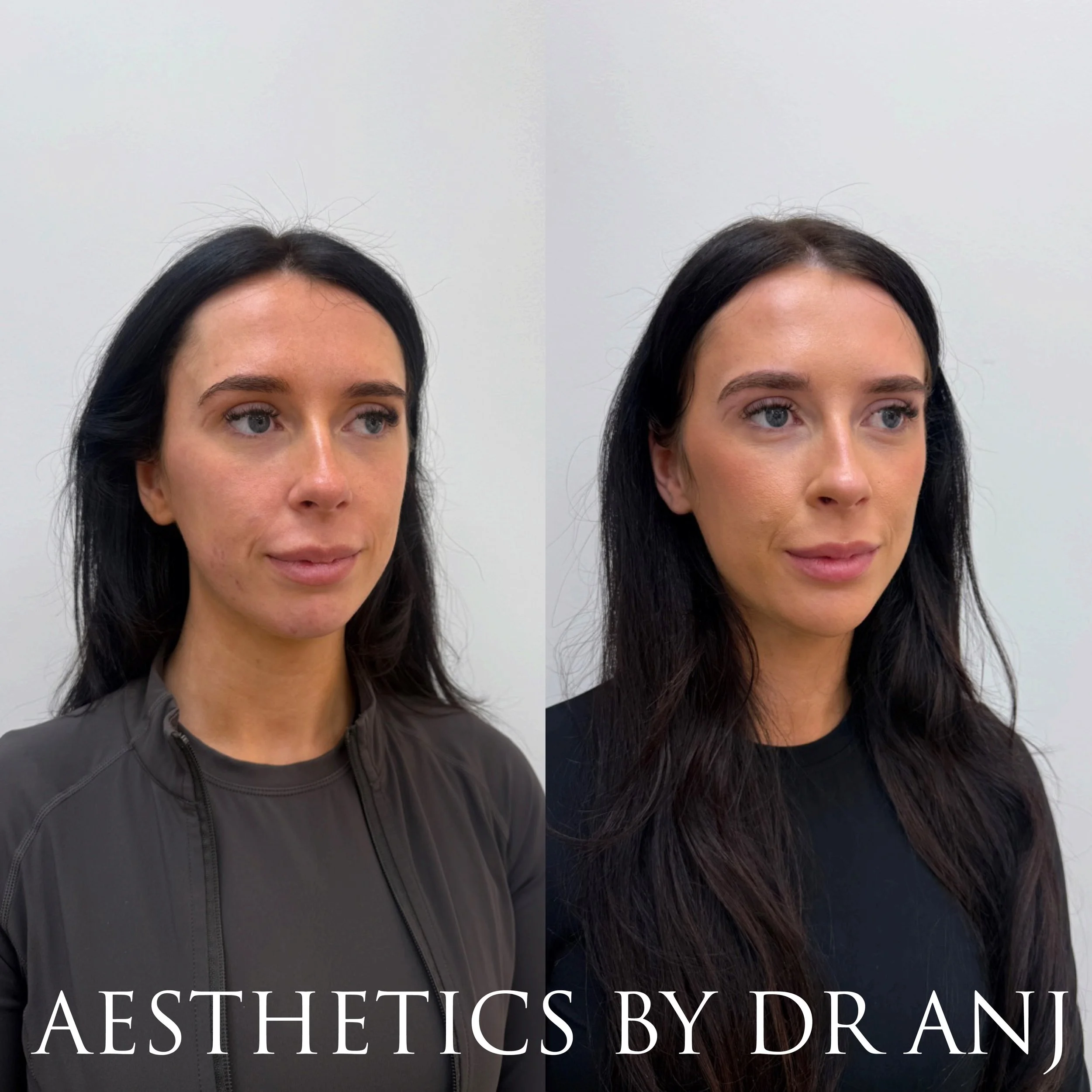 Full Facial Balancing: Filler to midface, chin, chin shadow