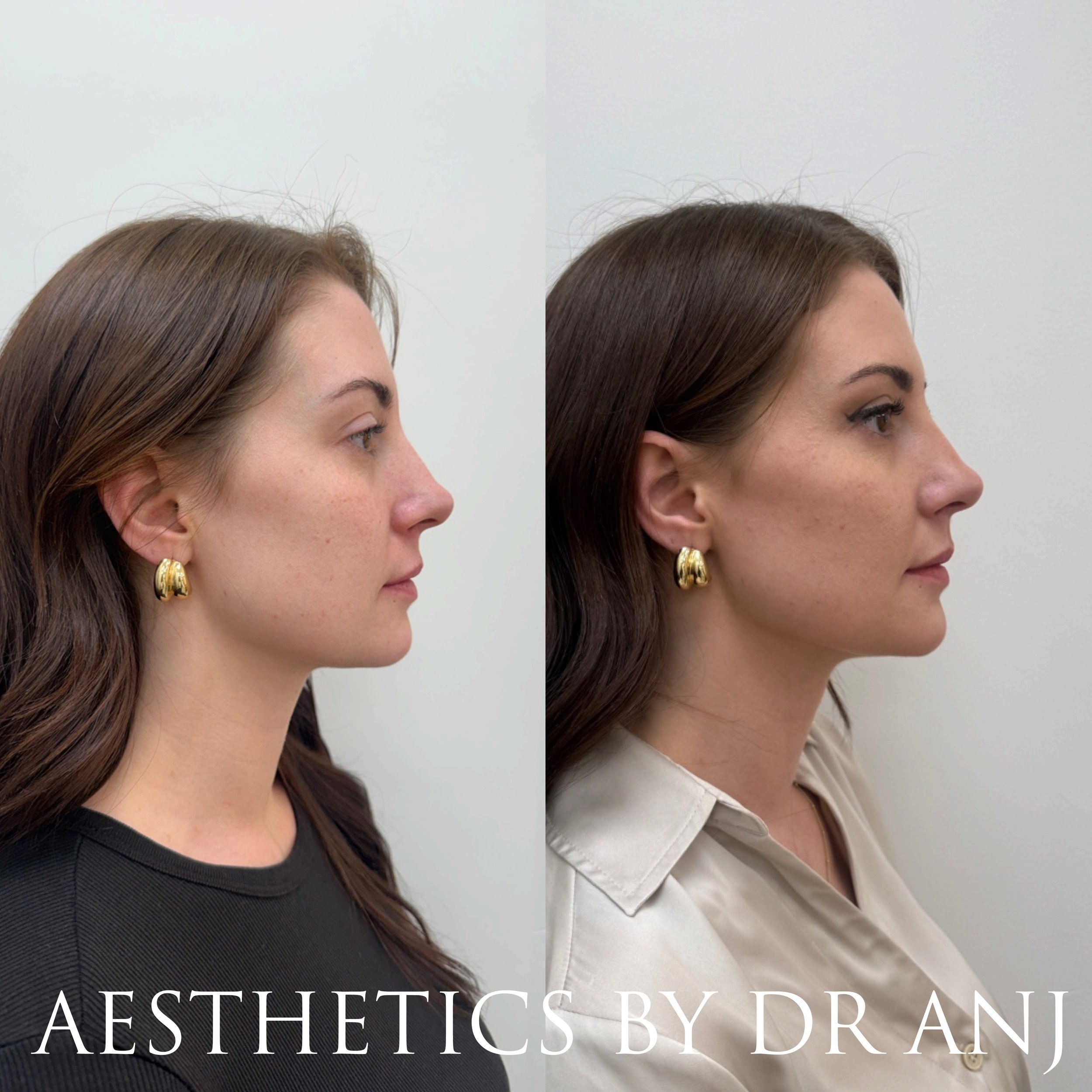 Full Facial Balancing: Filler to cheeks, nasolabial folds, chin and chin shadow