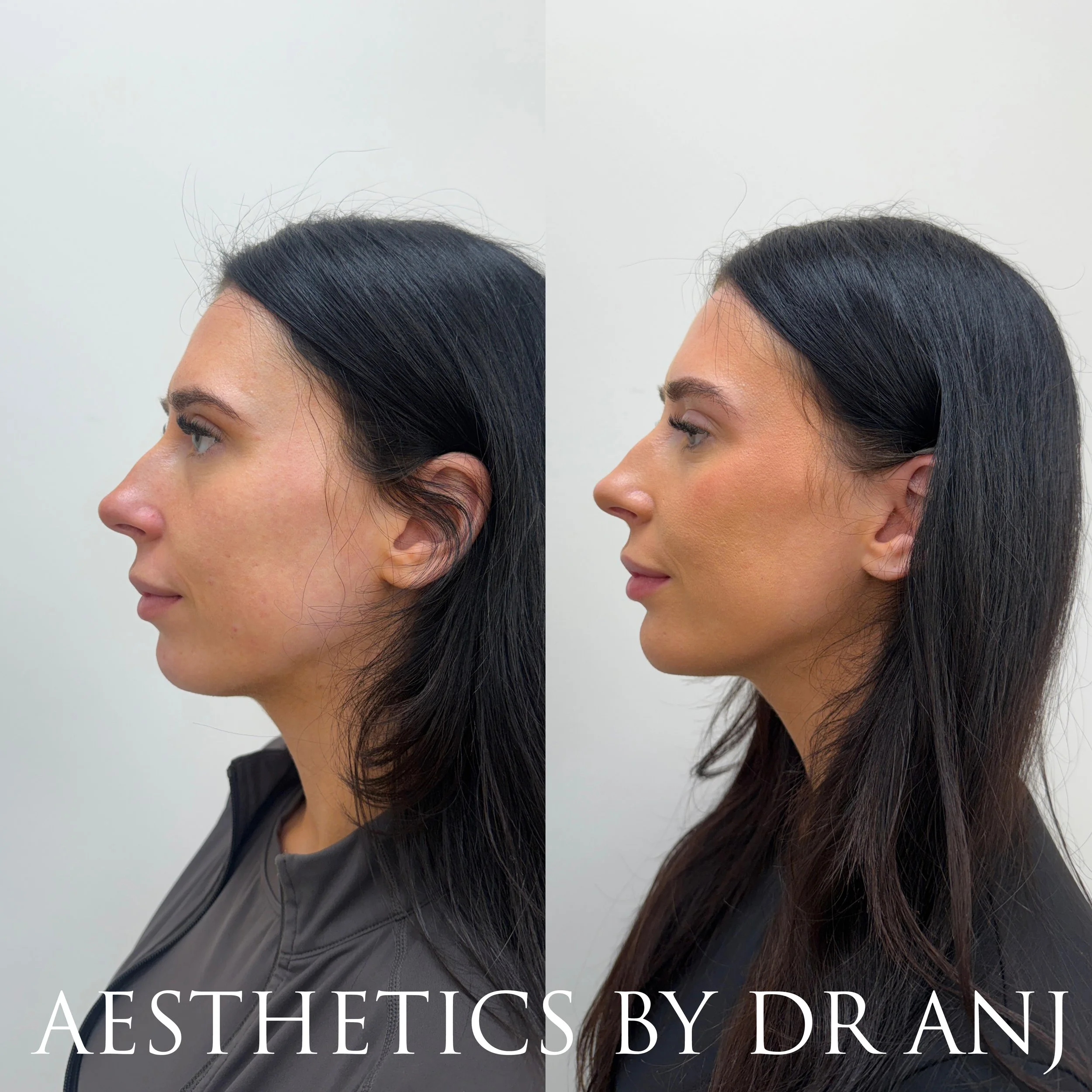Full Facial Balancing: Filler to midface, chin, chin shadow