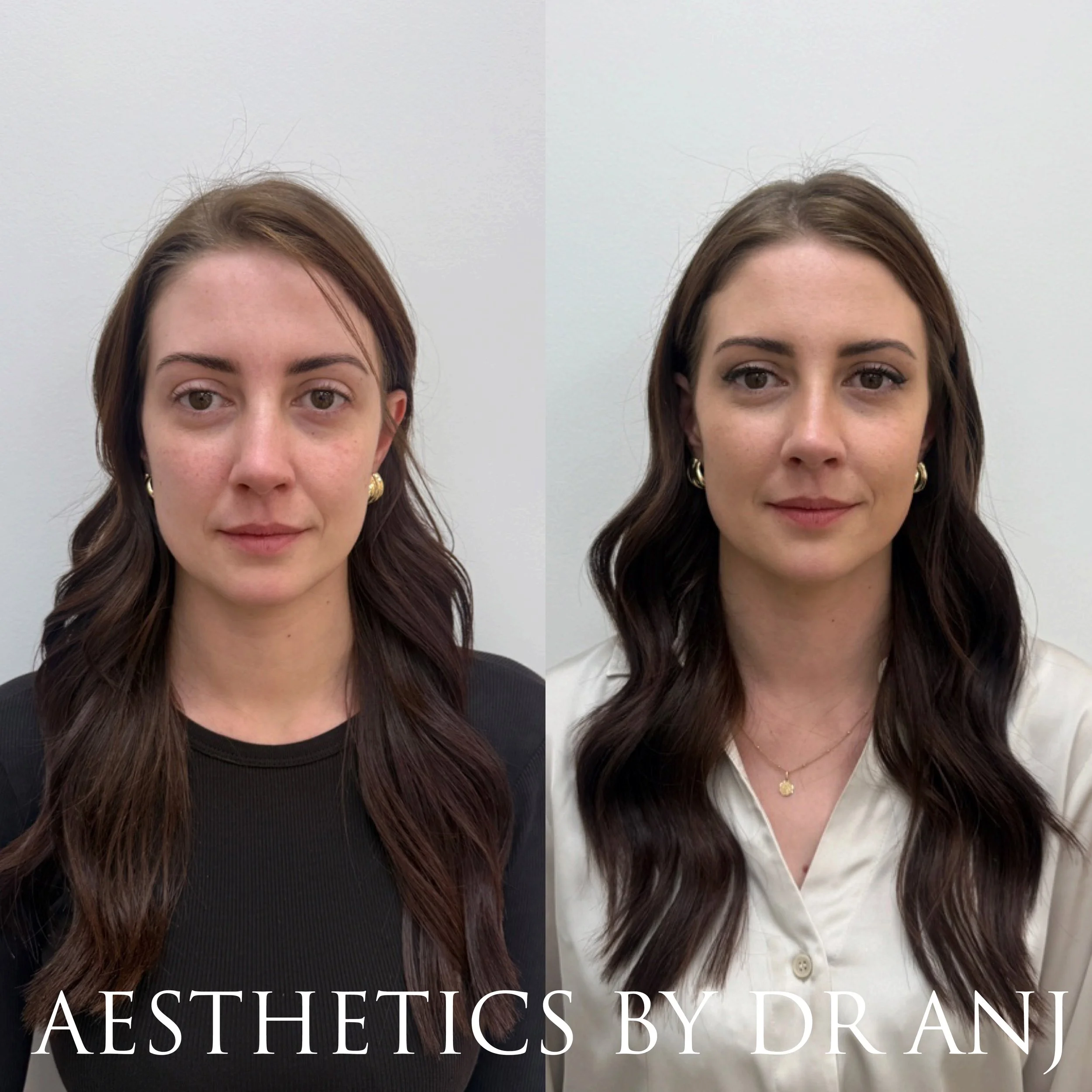 Full Facial Balancing: Filler to cheeks, nasolabial folds, chin and chin shadow 