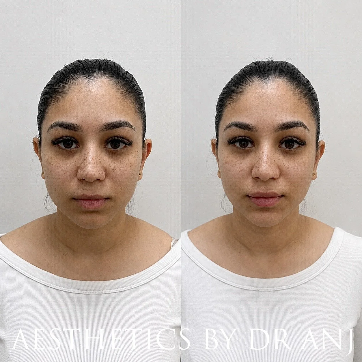 Lower Facial Balancing: Filler to lips, chin, chin shadow & jawline slimming (lips freshly done so swollen)