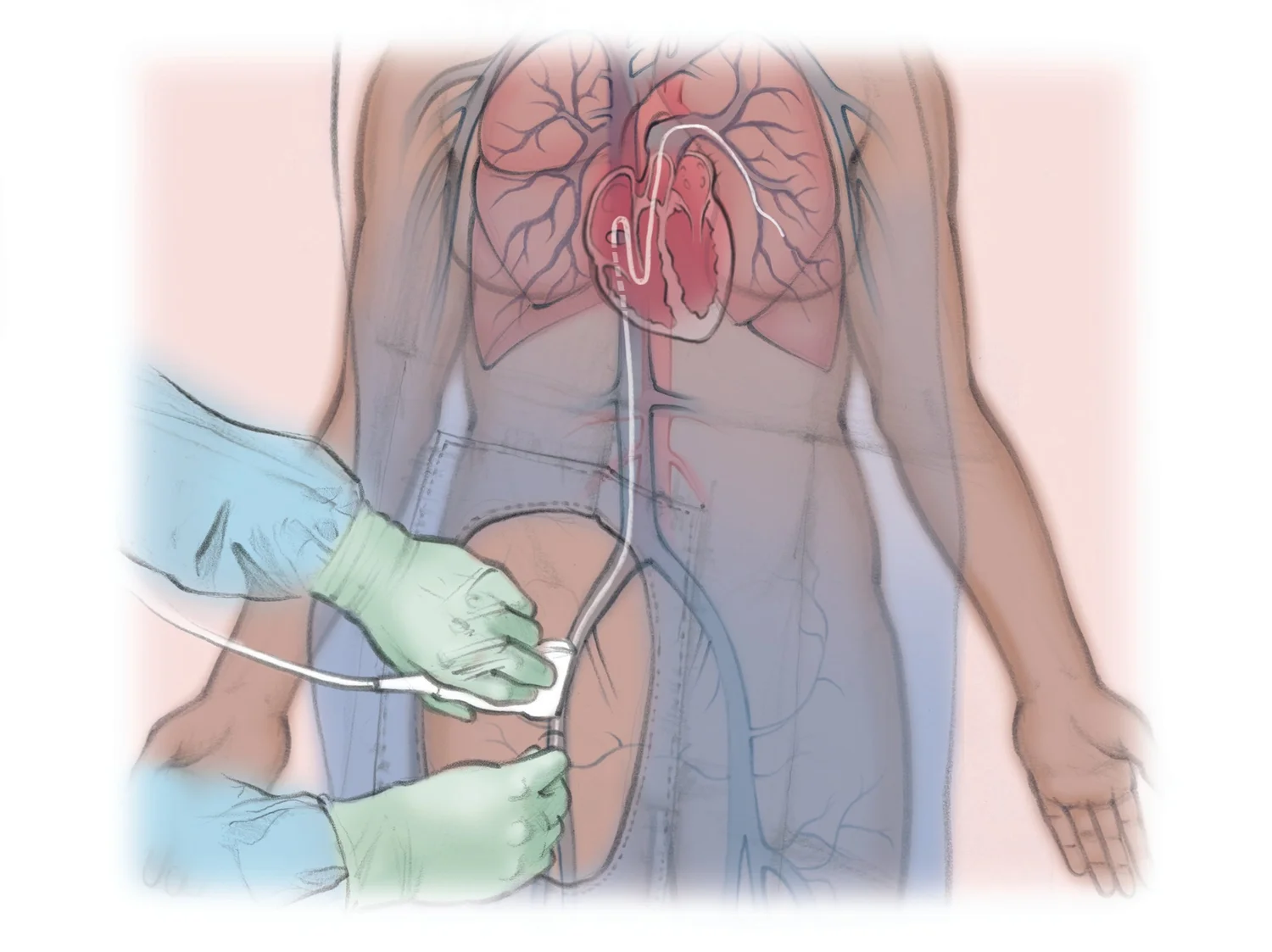 Embotech Avm Pulmonary AVM Embolization โ The Interventional Initiative