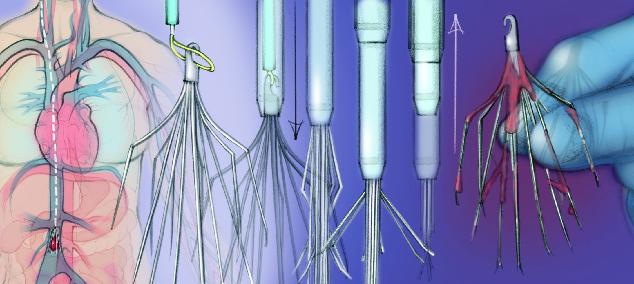 IVC Filter Removal The Interventional Initiative IVC Filter Removal The Interventional Initiative
