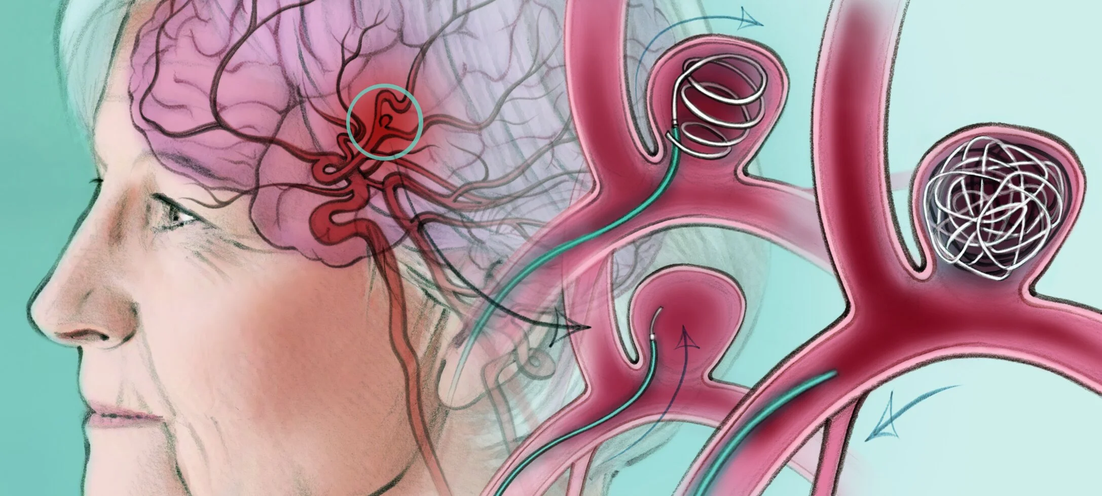 MIIP for Brain Aneurysms &mdash; The Interventional Initiative