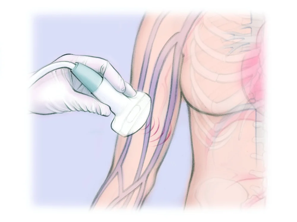 Picl Injection Peripherally-Inserted Central Catheter (PICC) — The Interventional ...