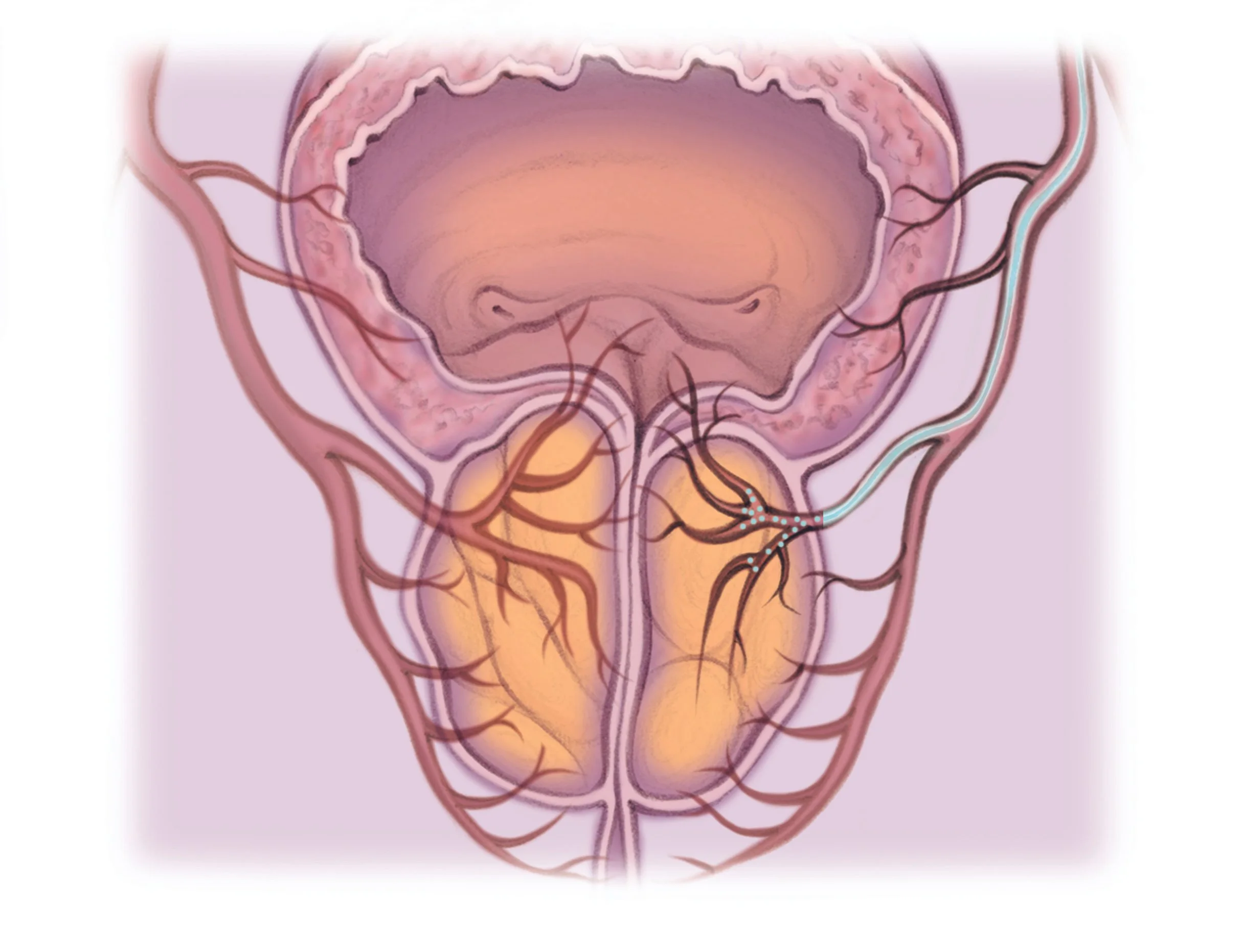 Prostate Block Prostate artery embolization — The Interventional Initiative