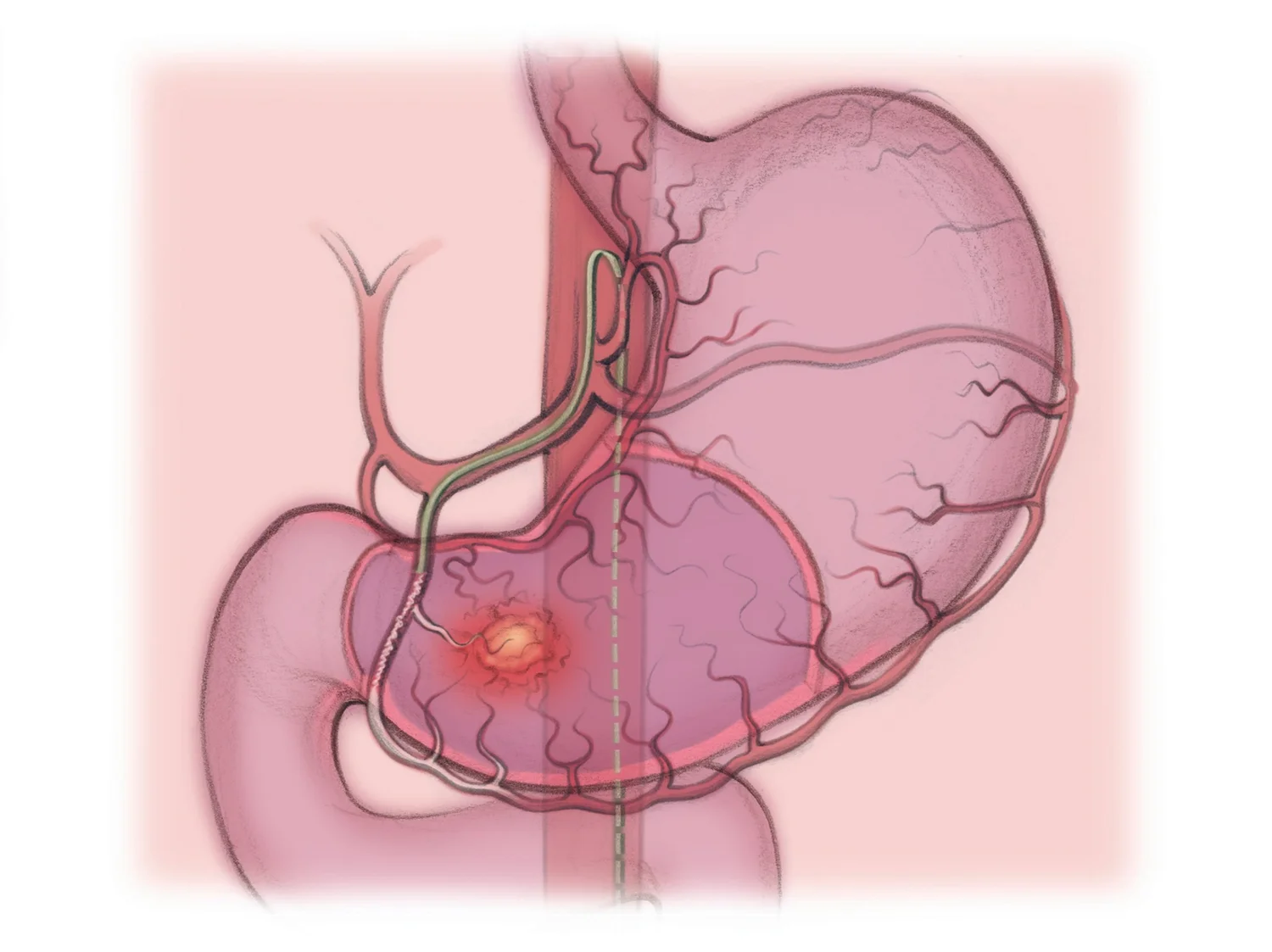 Embolization for Gastrointestinal Bleeding — The Interventional Initiative