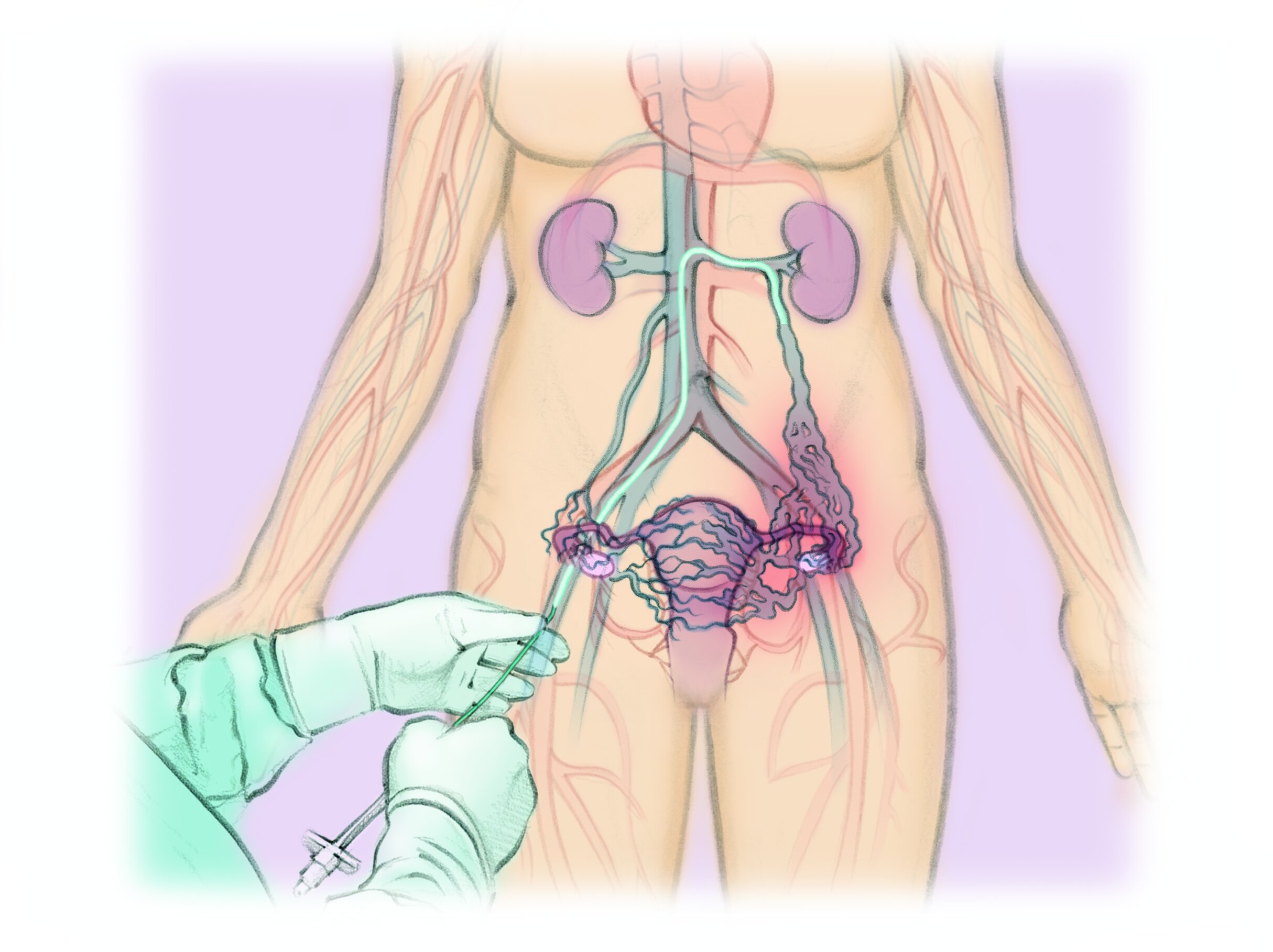 Pelvic Congestion Syndrome — The Interventional Initiative