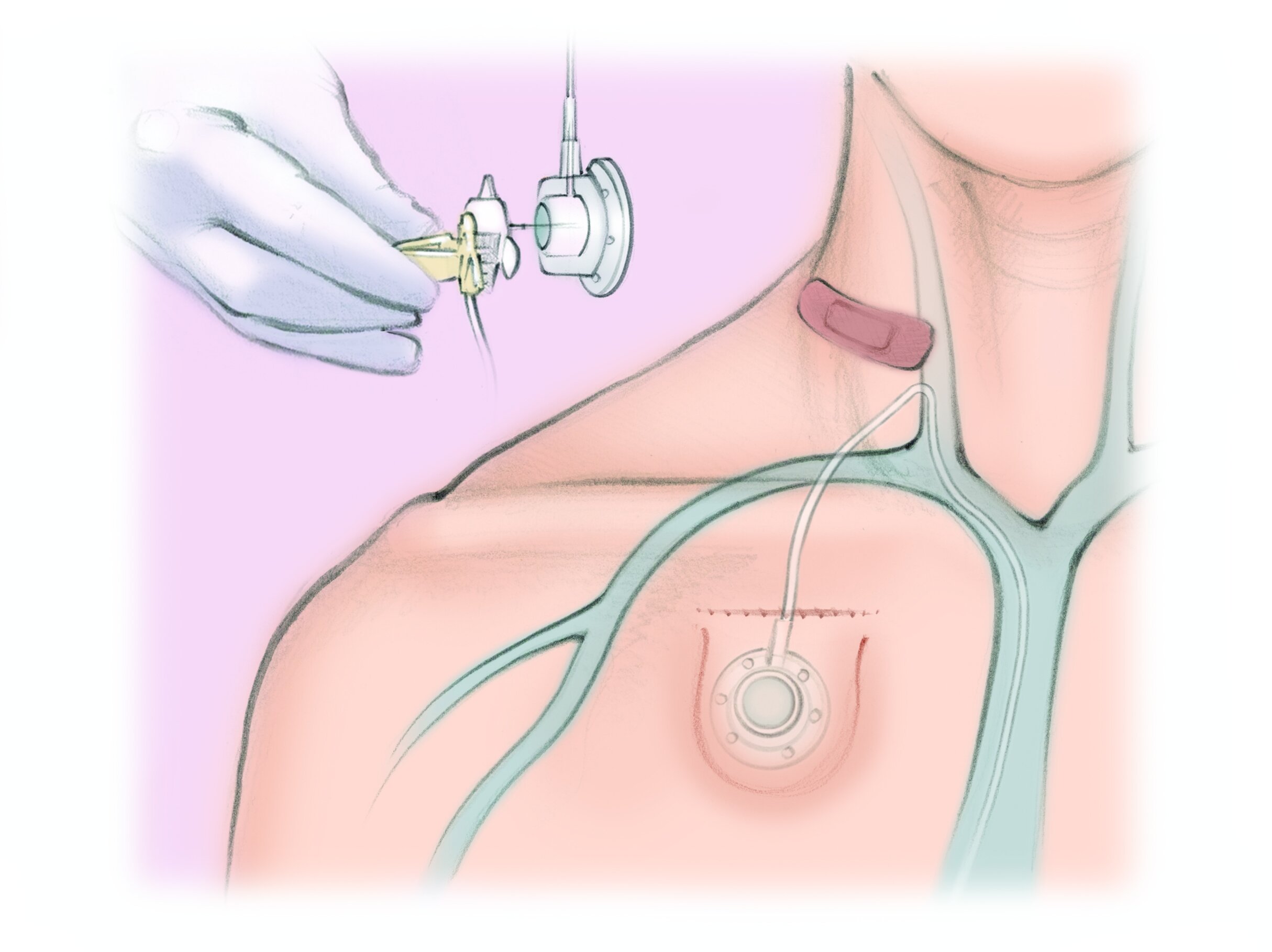 Port Placement — The Interventional Initiative