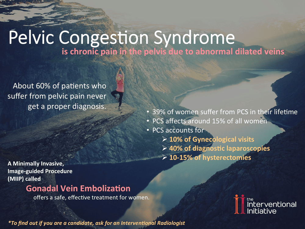 Can You Die From Pelvic Congestion Syndrome