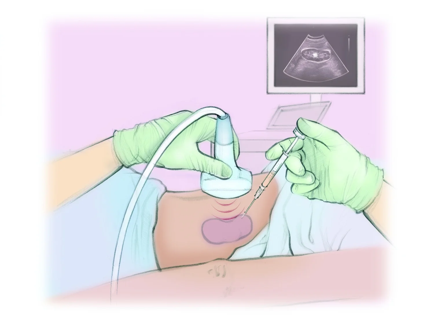 What is a Biopsy and why do I need one? — The Interventional Initiative