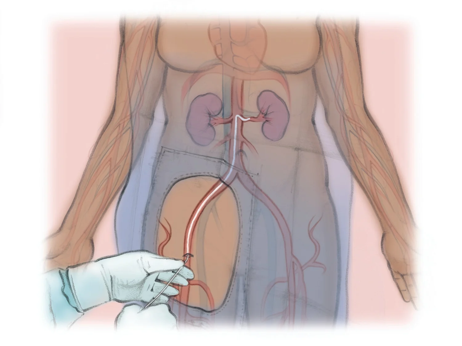Stents Rinones Renal Artery Stenting — The Interventional Initiative