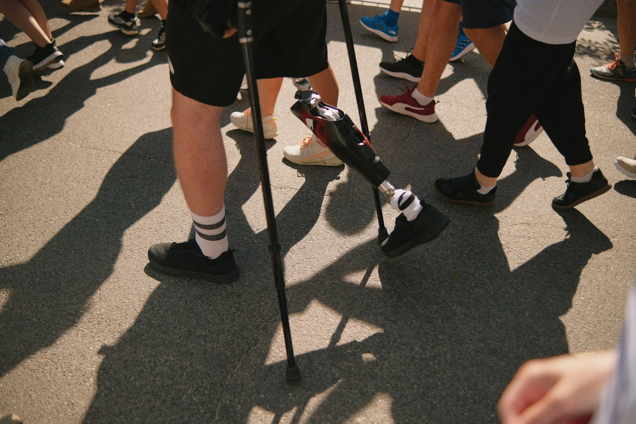 Signs Your Prosthetic Socket No Longer Fits (and What to Do About It)