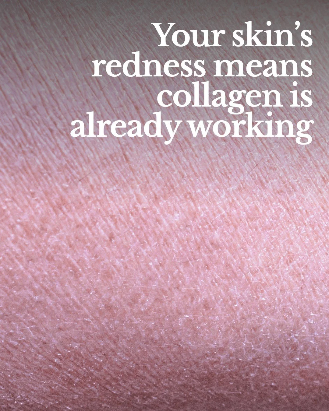 What happens to your skin right after treatment? Here's a quick guide:

&bull; Redness and slight swelling are normal as your skin starts its healing process.
&bull; Your skin may feel warm or sensitive&mdash;this is a sign that collagen production i