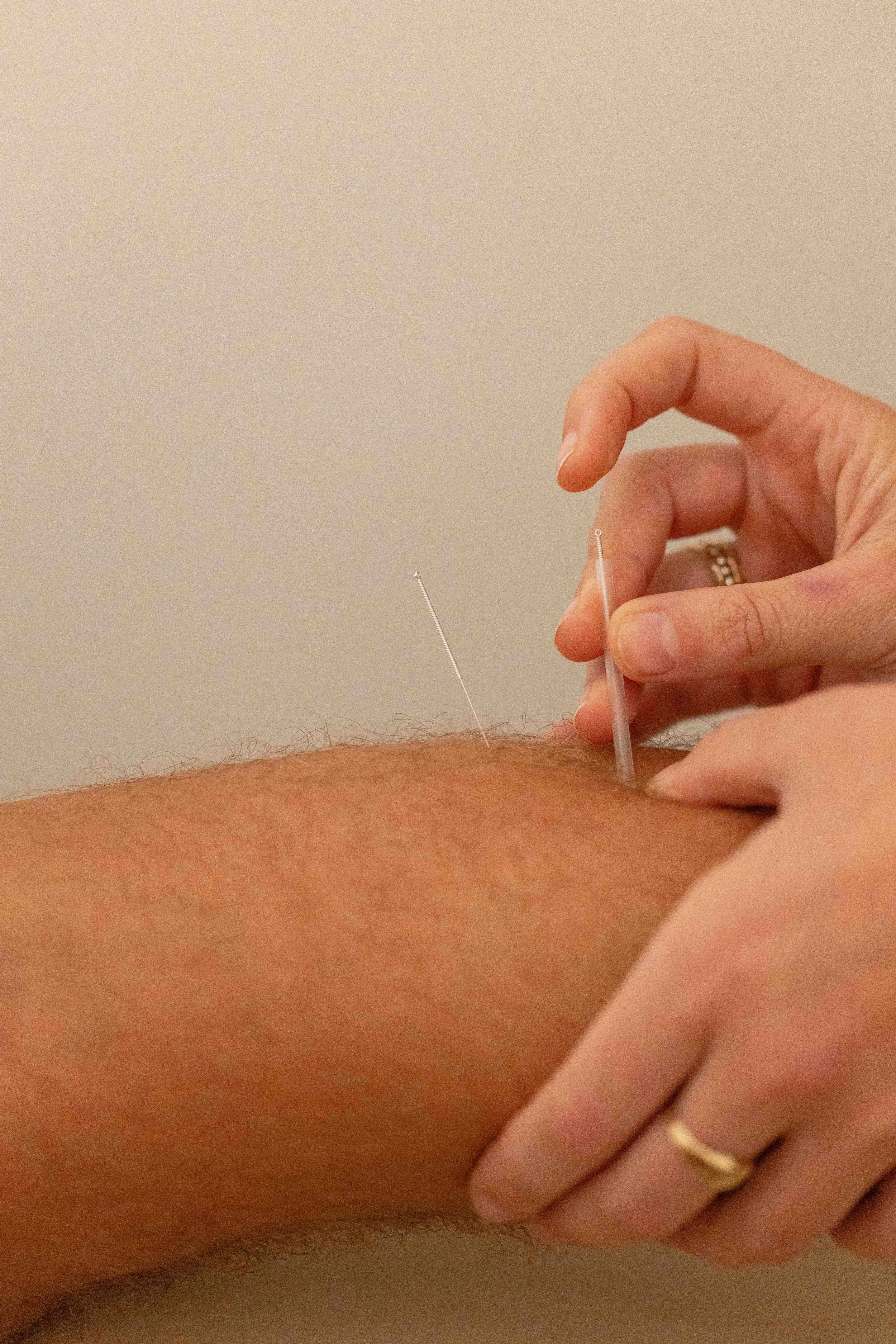 Dry needling physiotherapy in Brookvale, Freshwater, Manly, Curl Curl, Northern Beaches for pain and muscle tension