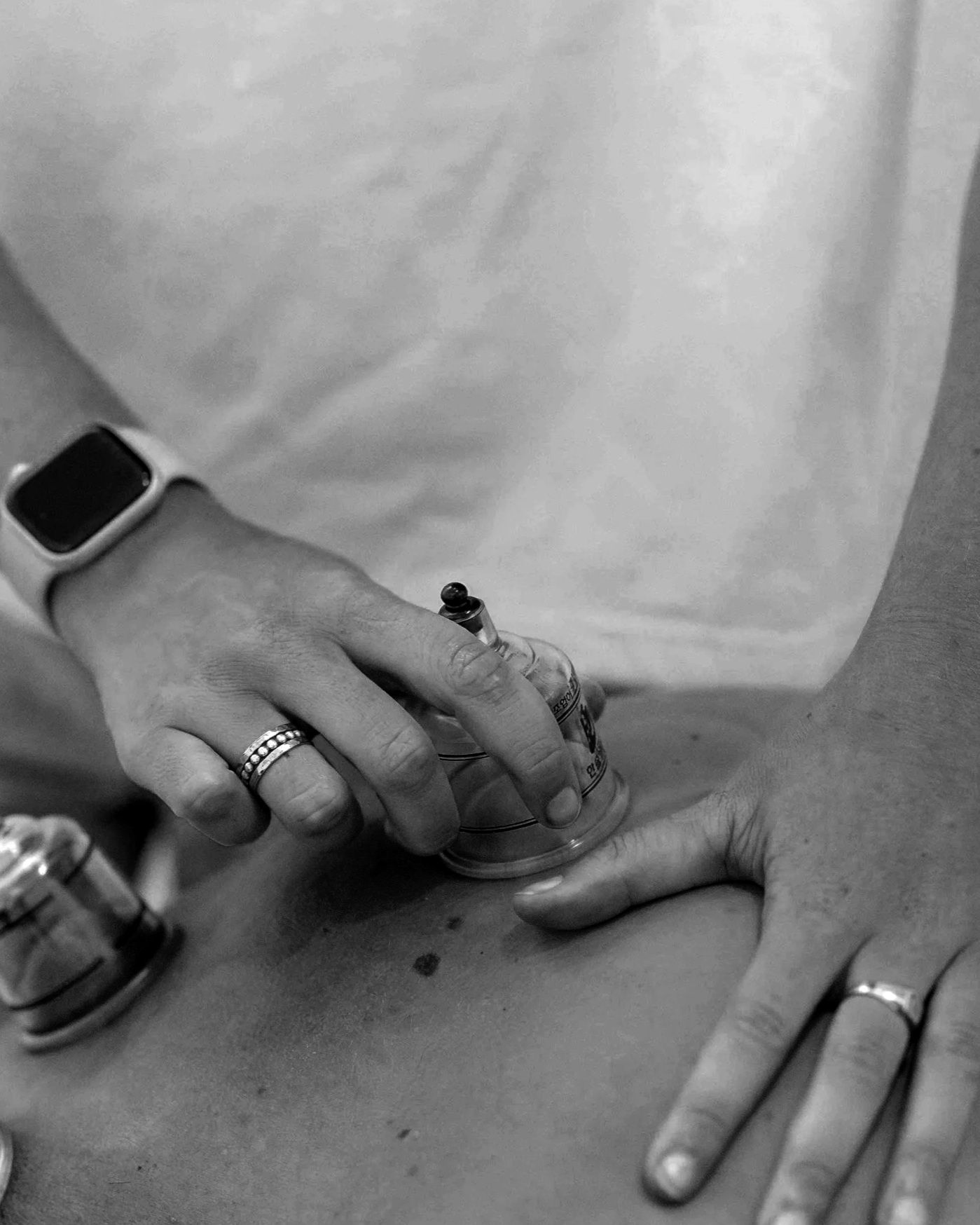 Perfectly Human Therapist Cupping Treatment Lower Back Pain Brookvale