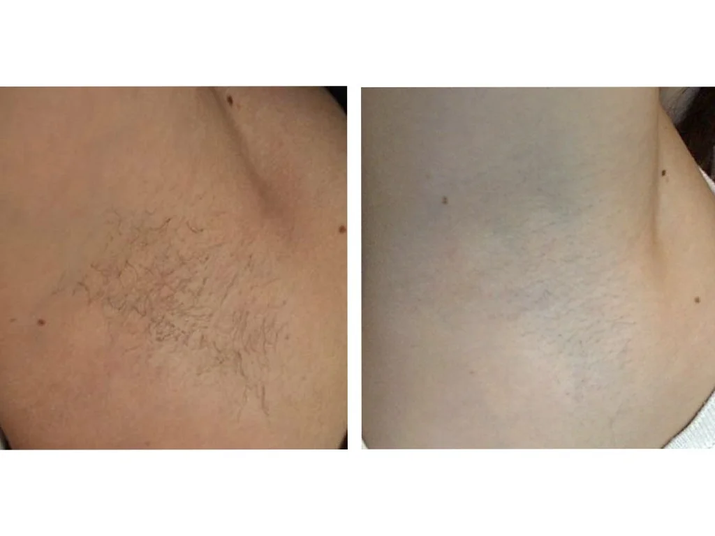 Hårborttagning av armhåla med IPL - före och efter 3 behandlingar.
