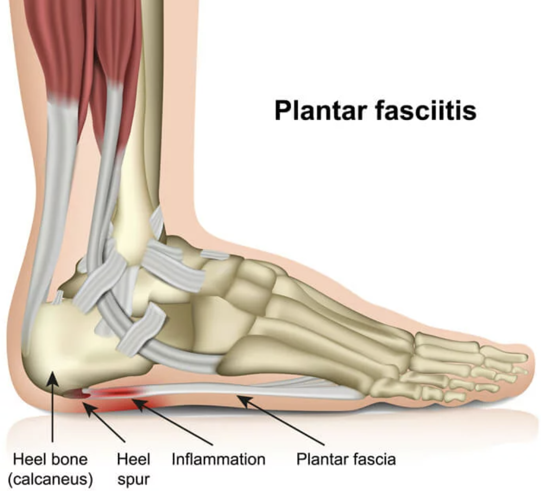 Diagram of a foot showing plantar fasciitis, with labels pointing to heel bone, heel spur, inflammation, and plantar fascia.