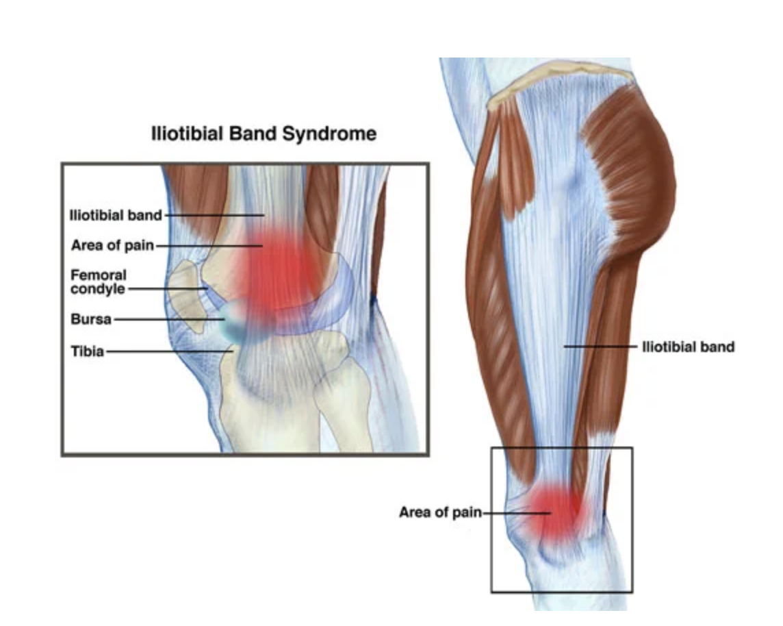 Diagram of Iliotibial Band Syndrome showing inflamed iliotibial band and pain areas in the knee and hip.