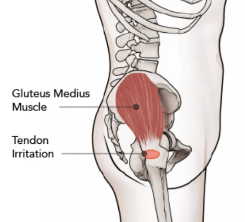 Diagram of a human pelvis showing the gluteus medius muscle and tendon irritation area, with labels indicating the muscle and irritation site.