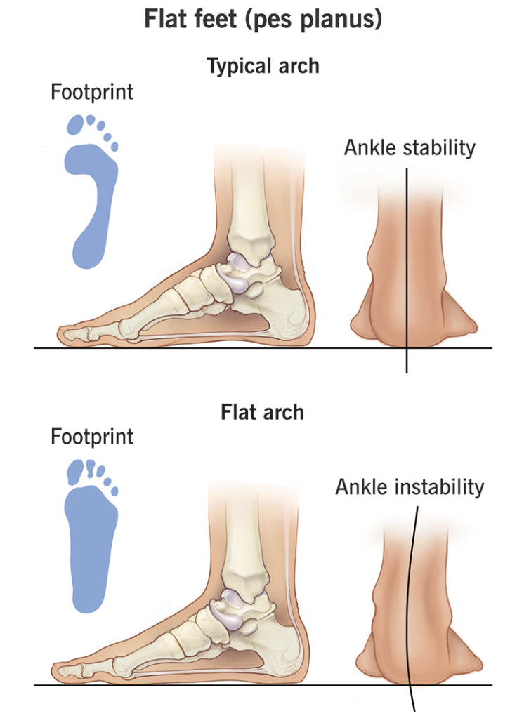 Should You Get Orthotics for Flat Feet? Here’s When They Actually Help
