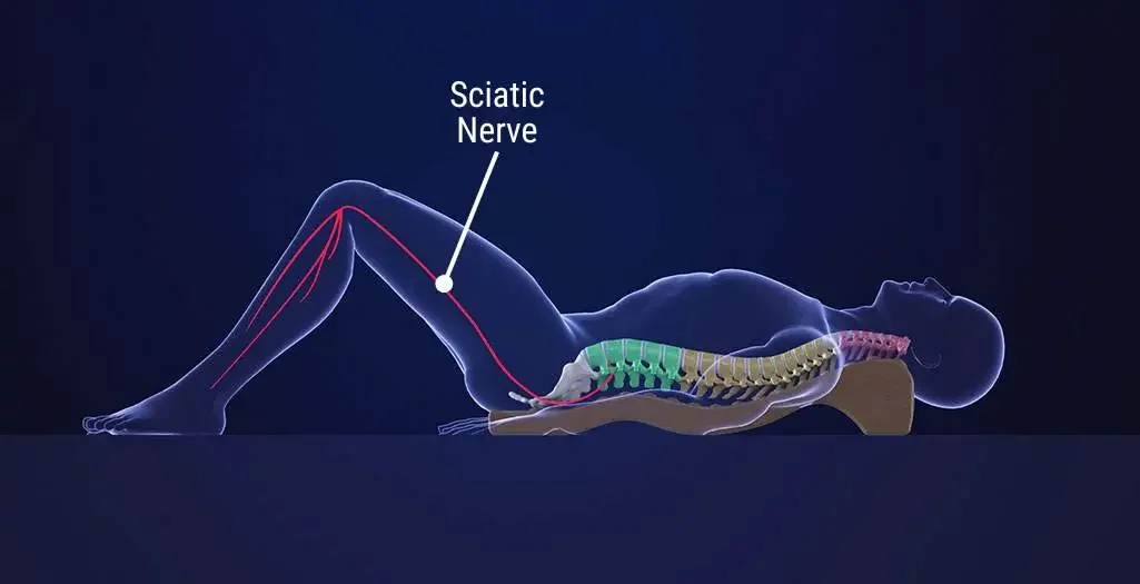 Sciatica: Why It Happens &amp; What You Can Do Beyond Painkillers
