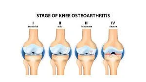 Why Your Knee Keeps Clicking: When It’s Harmless vs When It’s Not
