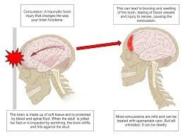 Concussion Protocols in Community Cricket: What Players Should Know