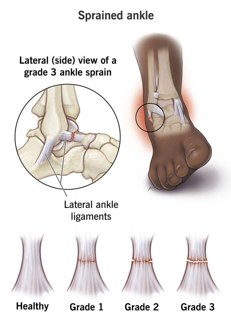 Diagram of a sprained ankle showing a lateral view of a grade 3 ankle sprain with damaged ankle ligaments, illustrating progressive severity from healthy to grade 3 ligament tears.