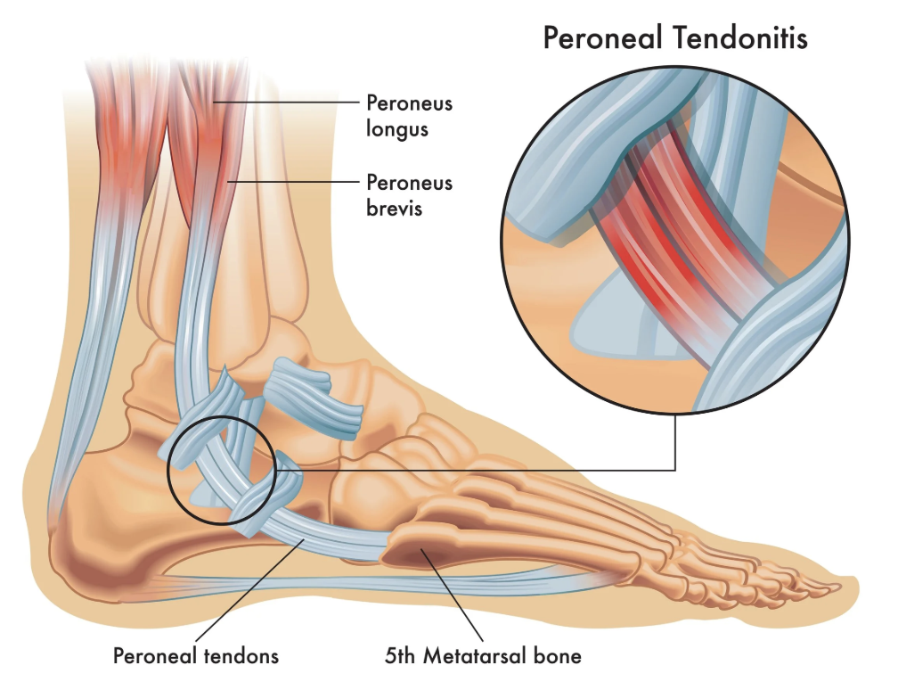 Illustration of the anatomy of the ankle and foot showing peroneal tendons, peroneus longus and brevis, 5th metatarsal bone, and peroneal tendinitis with a detailed close-up of inflamed tendons.