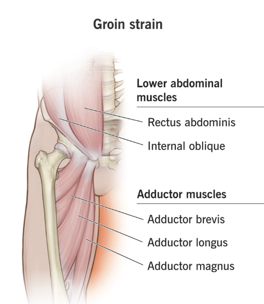 Diagram of the groin strain muscles showing lower abdominal muscles, rectus abdominis, internal oblique, and adductor muscles including adductor brevis, longus, and magnus.