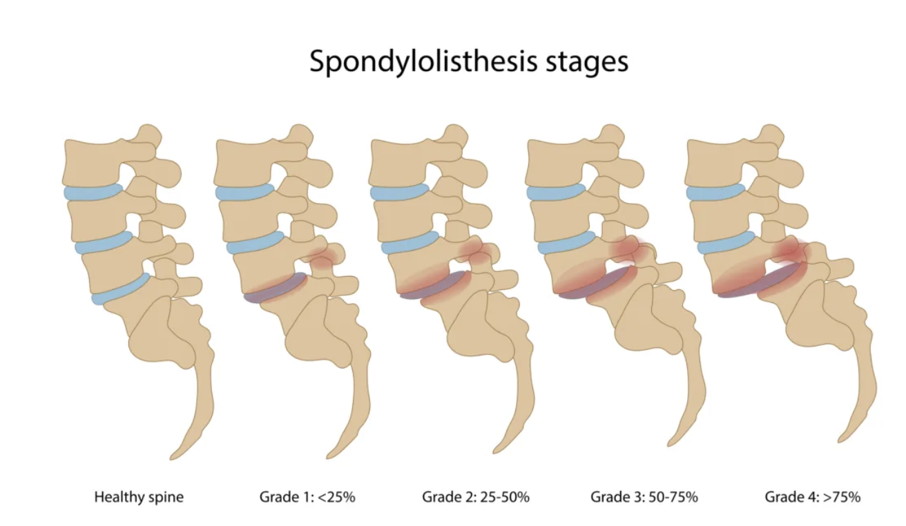 Diagram illustrating stages of spondylolisthesis from healthy spine to Grade 4, showing increasing vertebral slippage and spinal degeneration.