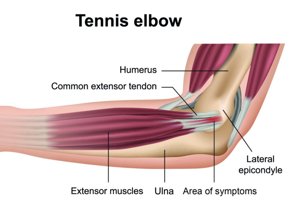 Diagram of a human arm showing the anatomy of a tennis elbow, including the humerus, common extensor tendon, extensor muscles, ulna, lateral epicondyle, and area of symptoms.