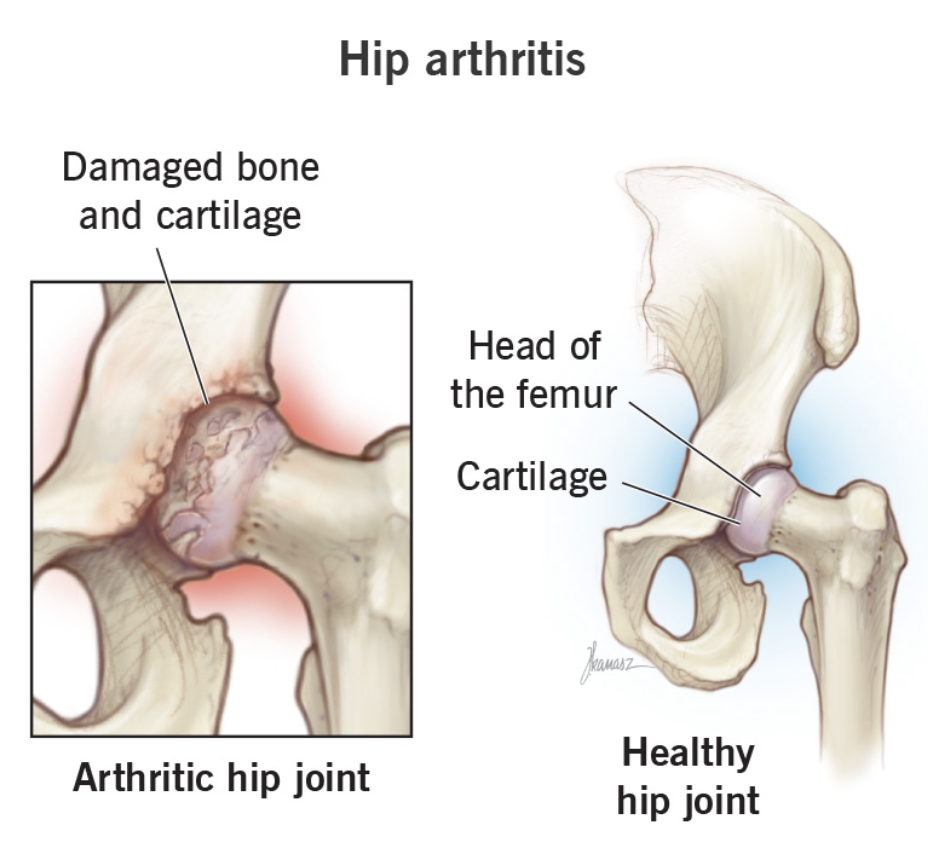 Comparison of a healthy hip joint and an arthritic hip joint. The healthy hip joint shows a smooth cartilage surface and a properly aligned head of the femur within the joint socket. The arthritic hip joint shows damaged bone and cartilage with rough, irregular surfaces, indicating deterioration and inflammation.