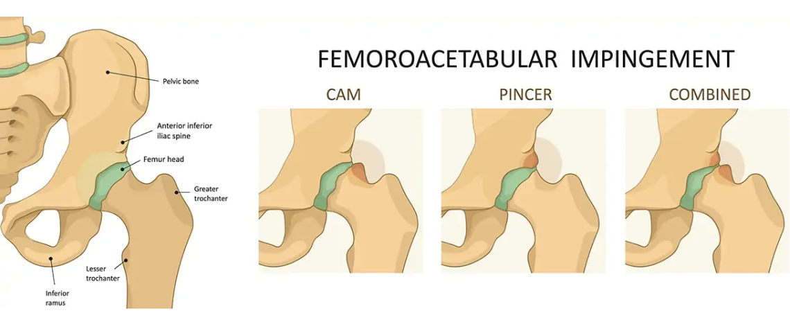 Diagram of femoroacetabular impingement showing cam, pincer, and combined types, with illustrations of the pelvis bone, acetabulum, and femoral head.