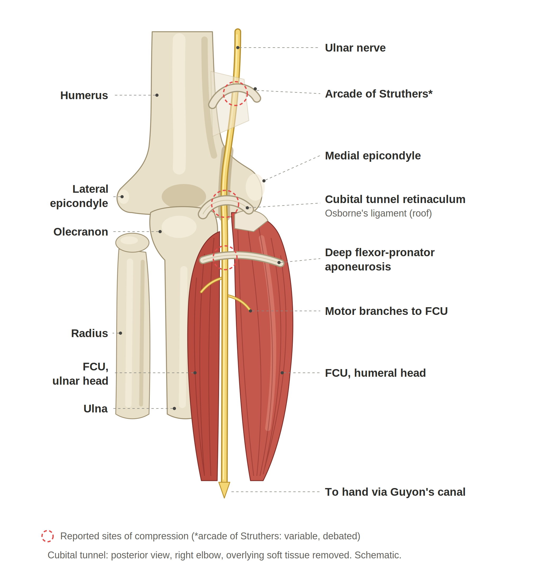 Diagram of the anatomy of the humerus, illustrating the ulnar nerve, arcade of Struthers, medial epicondyle, cubital tunnel retinaculum, deep flexor-pronator aponeurosis, and motor branches to the flexor carpi ulnaris and humeral head, with labels and a schematic arrow indicating hand direction via Guyon's canal.