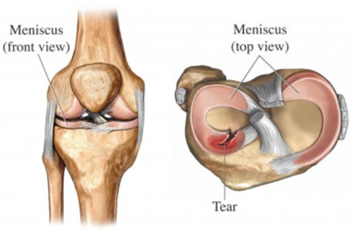 Diagram of a human knee showing the meniscus in front view and top view, with a tear indicated.