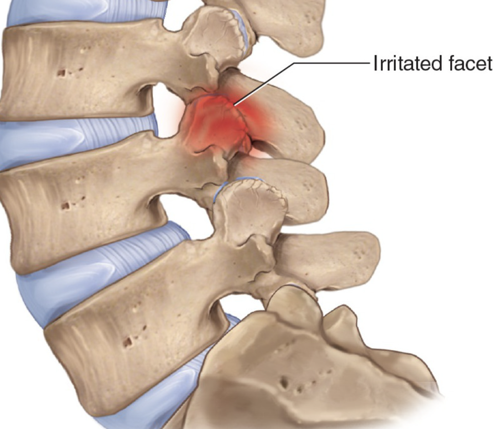Illustration of a spine showing irritated facet joint, highlighted with red and labeled 'Irritated facet'.