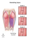 How to Recover from a Hamstring Strain – A Physio’s Guide — Thrive ...
