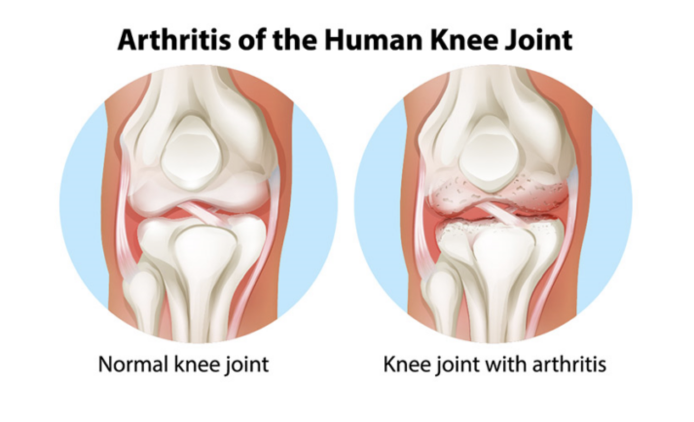 Comparison of a normal knee joint and a knee joint with arthritis, showing inflamed and damaged cartilage in the arthritic knee.