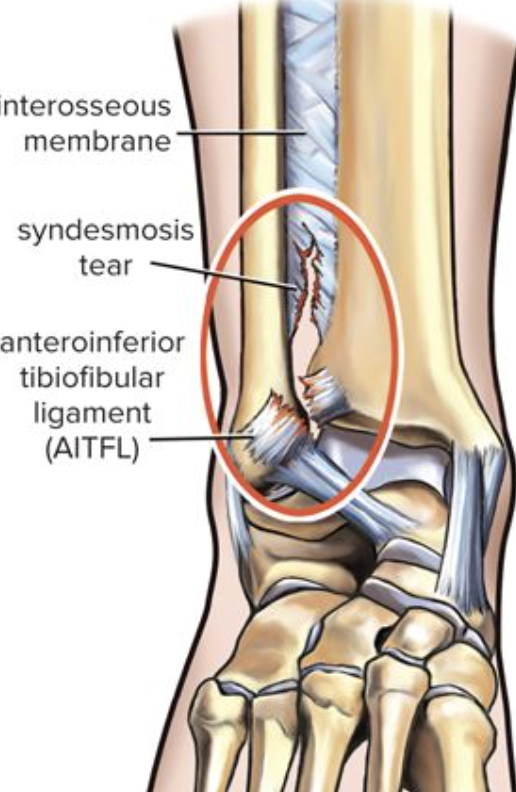 Diagram of a torn Anterior Inferior Tibiofibular Ligament (AITFL) in the ankle, showing a syndesmotic tear with labels for the interosseous membrane, syndesmotic tear, and ligaments.