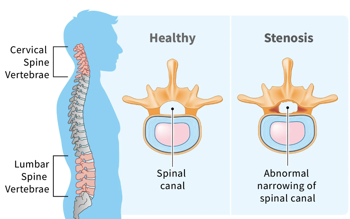 Illustration comparing a healthy spinal canal with a narrowed spinal canal causing stenosis, showing the cervical and lumbar spine with vertebrae, and cross-section views of the spinal canal.